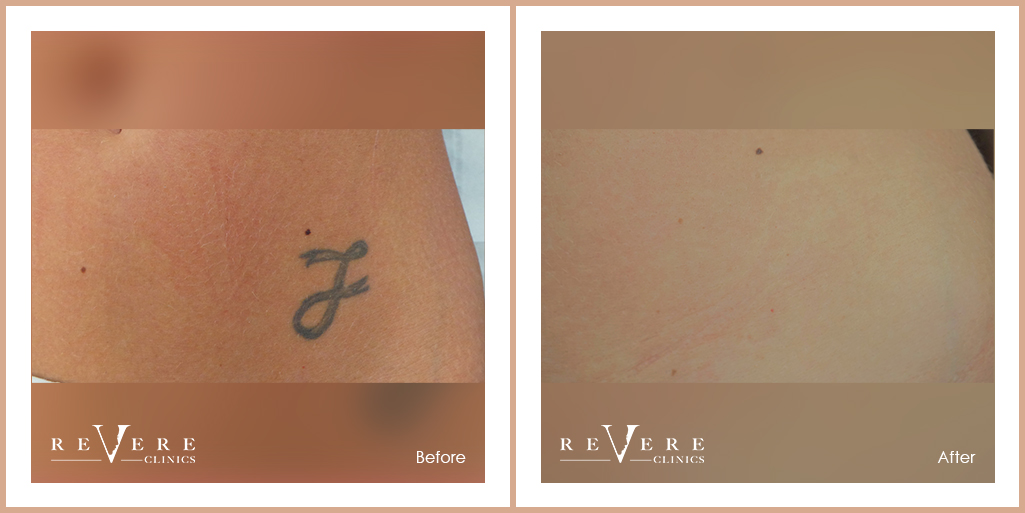 picosure laser tattoo removal london