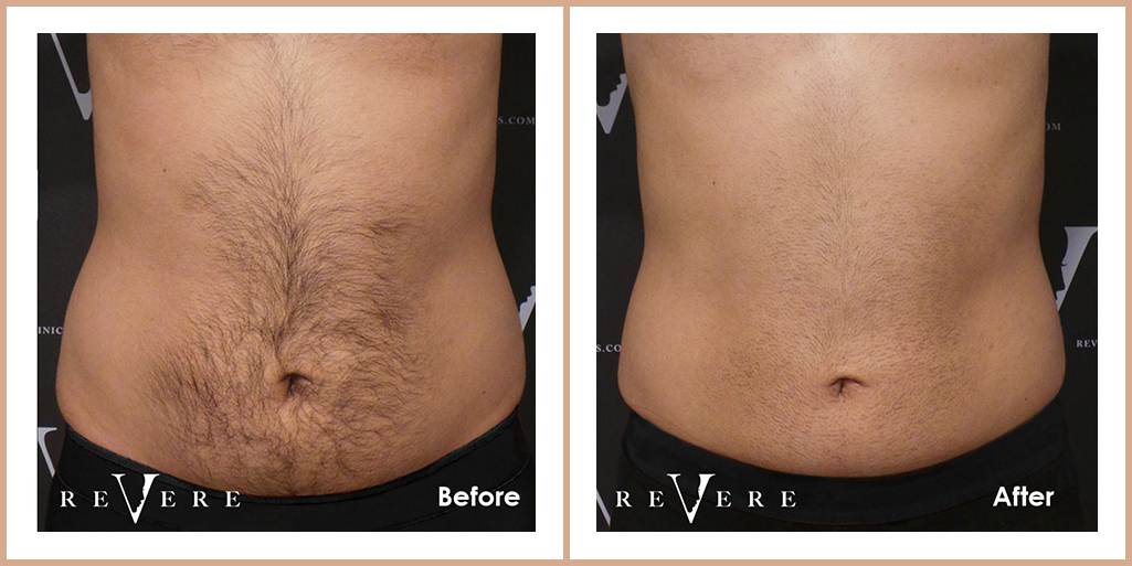 Coolsculpting Revere