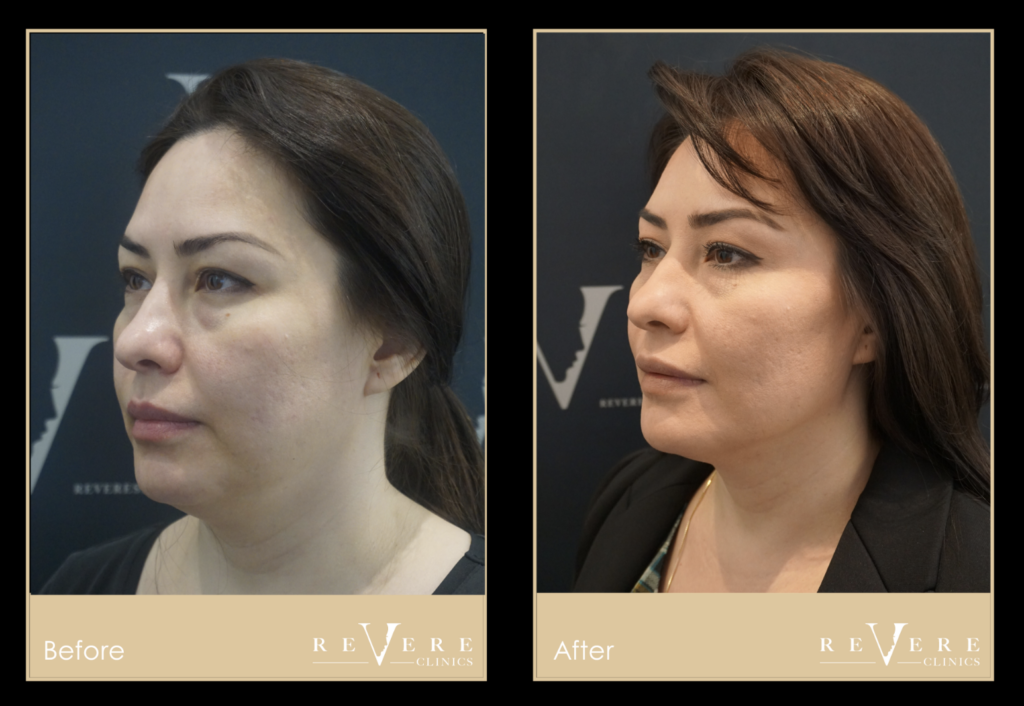 Fat loss facelift